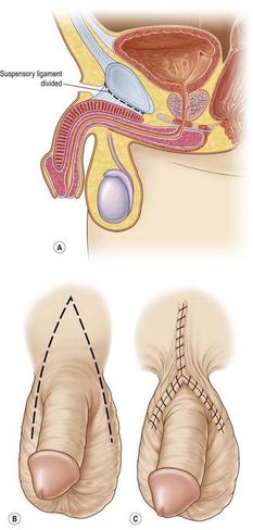 Penile lengthening