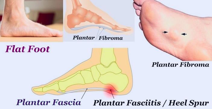 Foot Pain - Common Causes & Locations