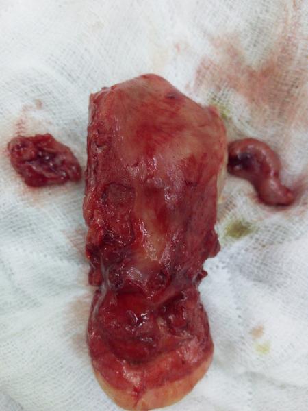 no scar uterus removal