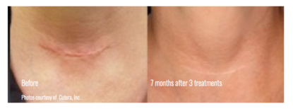 Cosmetic Injectables Center, Encino, Sherman Oaks Botox, Fillers, Restylane, Juvaderm, laser genesis, skin, pigmentation, redness, tightening, wrinkles