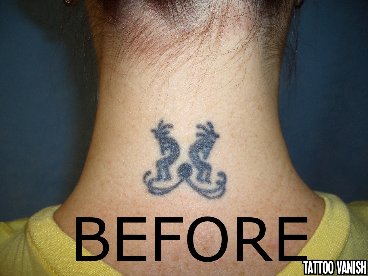 14+ Tattoo Vanish Cost PNG