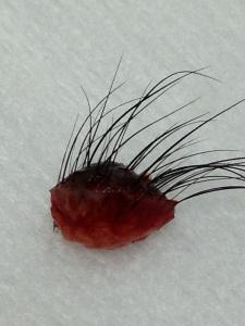 近鏡觀察一粒已經被切了出來的，巨大的，有毛長出來的黑色的墨痣