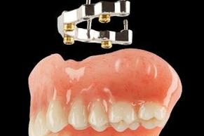 Denture On Implants With Bar Michel Puertas Denturologiste Brossard-Laprairie