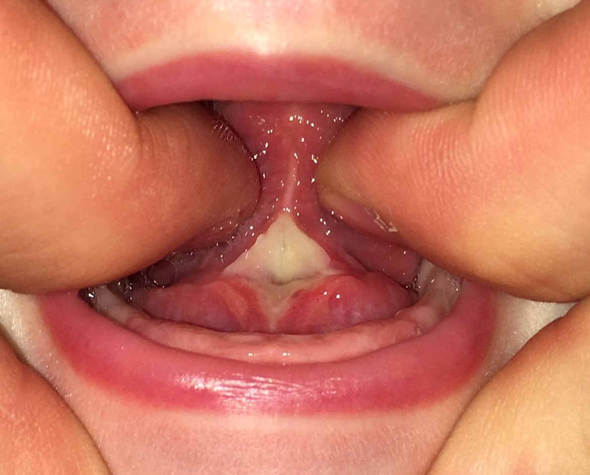 lingual frenulum cut