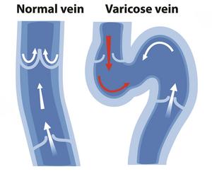 Varicose Veins Support Group: VariStop.com