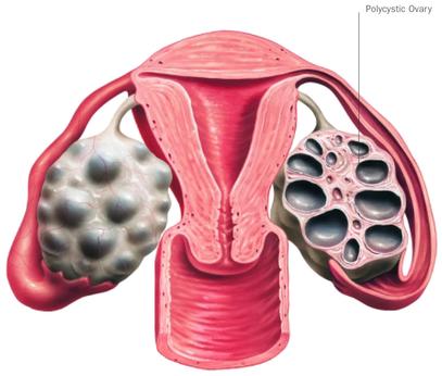 best pcos treatment in goa