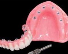 Prothèse Dentaire Fixe Sur Implants Michel Puertas Denturologiste Brossard-Laprairie, Fixed Denture On Implants Michel Puertas Denturologiste Brossard-Laprairie