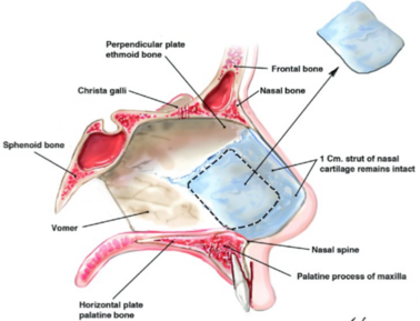 Cartilage RHINOPLASTY