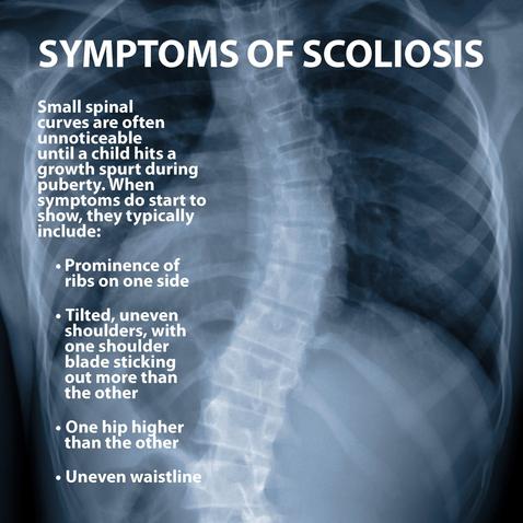 Scoliosis Treatment - Action Sports Chiropractic