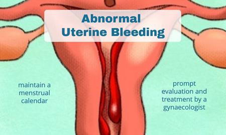 ABNORMAL UTERINE BLEEDING – Types, Causes and Risk Factors, Clinical Manifestations, Diagnostic Evaluations and Management