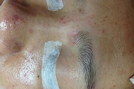 激光脫墨後呈現一個平坦的，沒流血的，沒有顏色的，不明顯的傷口