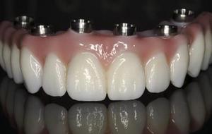 Fixed Denture On Implants Michel Puertas Denturologiste Brossard-Laprairie