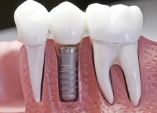 couronne dentaire sur implant dentaire Brossard-Laprairie