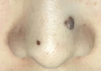 2 nevi on the nose