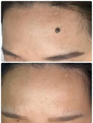 a before and after picture showing co2 laser removal of a dark mole on left forehead with minimal scarring