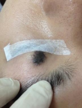 a flat, black, big mole located on left upper eyelid