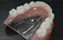 Complete Denture Michel Puertas Denturologiste Brossard-Laprairie