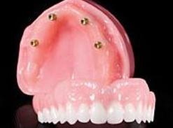 Denture On Implants Michel Puertas Denturologiste Brossard-Laprairie
