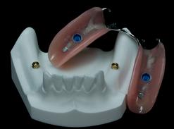 PARTIAL DENTURE ON IMPLANTS "CLICK" Michel Puertas Denturologiste Brossard-Laprairie