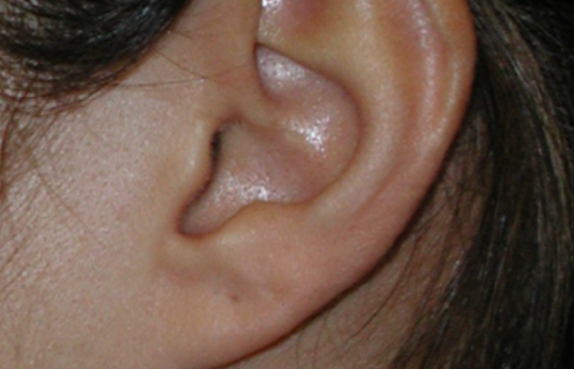 Ear Tumor - Dr. Joel Wallach