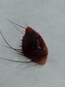 an excisional biopsy specimen, a black hairy skin mole