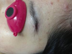由於疤痕隱藏在眉毛之內，拆線後幾乎看不見疤痕