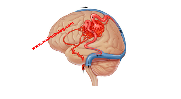 Vascular Dementia - Dr. Joel Wallach