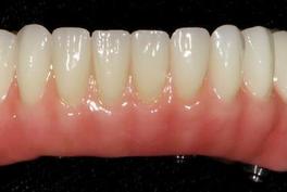 Fixed Denture Fix-On-Zircon Brossard-Laprairie