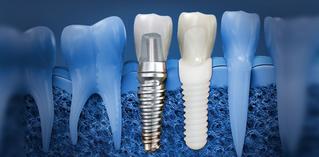 dental implant Brossard-Laprairie