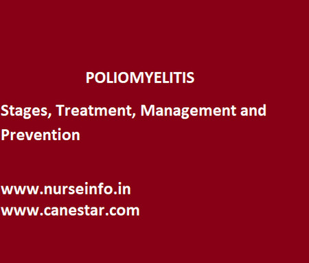 POLIOMYELITIS – Stages, Treatment, Management and Prevention