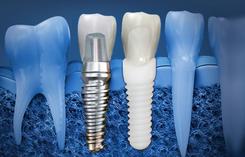 dental implant Brossard-Laprairie