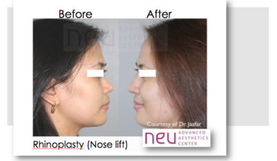 Rhinoplasty before and after photos