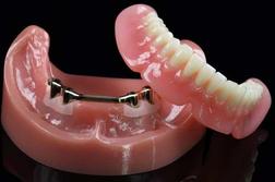 Denture On Implants With Bar Brossard-Laprairie