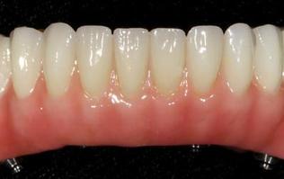 Fixed Denture On Implants Michel Puertas Denturologiste Brossard-Laprairie