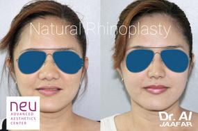 Rhinoplasty before and after photos