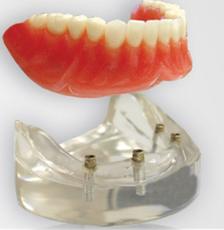 Dental complete lower denture on 4 dental implants Brossard-Laprairie