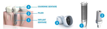 Couronne sur implant Clinique Implantologie Dentaire