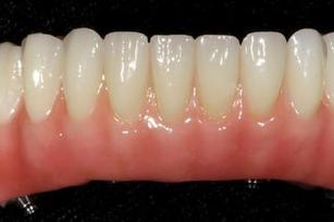 Prothèse Dentaire Fixe Fix-On-Zircon Michel Puertas Denturologiste Brossard-Laprairie, Fixed Denture Fix-On-Zircon Michel Puertas Denturologiste Brossard-Laprairie
