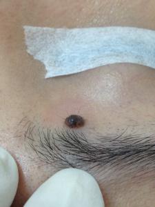 位於上眼皮，接近眼眉毛的黑色的墨痣