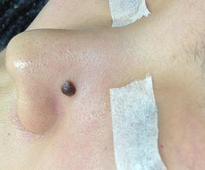 a brown, protruding mole situated on left nose bridge above left ala