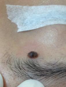 a dark brown hairy naevus locates under the medial side of the right eyebrow