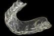 Plaque Occlusale Michel Puertas Denturologiste Brossard-Laprairie, Occlusal Splint Michel Puertas Denturologiste Brossard-Laprairie
