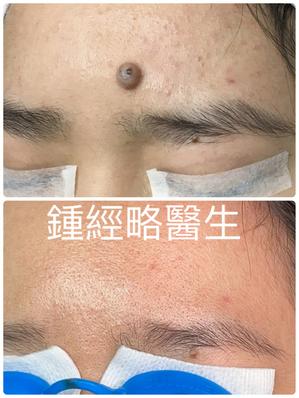 a before and after photo of removal of a large brown skin mole on forehead