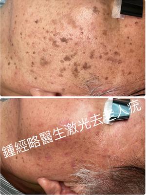Comparison photo showing co2 laser removal of numerous seborrheic keratosis on left face with minimal scarring