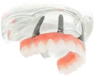 prothèse fixe sur implants Brossard-Laprairie, fixed denture on implants Brossard-Laprairie