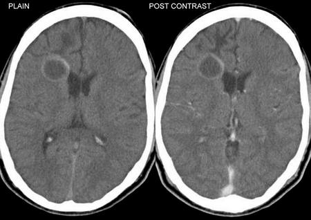 BRAIN ABSCESS – Causes and Risk Factors, Pathophysiology, Clinical Manifestations, Diagnostic Evaluations and Management