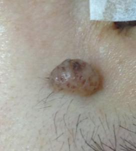 近鏡觀察一粒位於眉毛下方，近鼻樑位置的，淺啡色的， 凸出皮膚表面的墨痣
