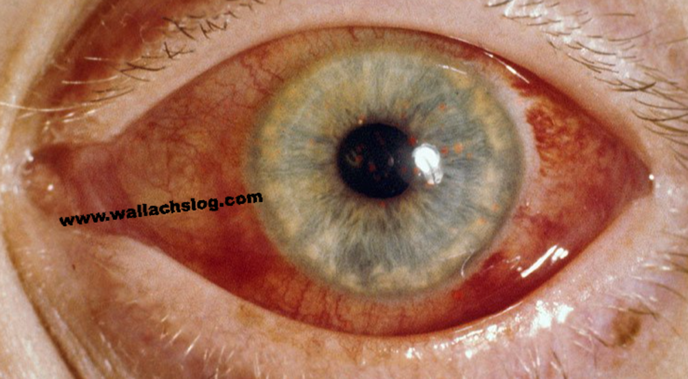 Glaucoma - Dr. Joel Wallach