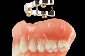 Prothèse Dentaire Sur Implants Avec Barre Michel Puertas Denturologiste Brossard-Laprairie, Denture On Implants With Bar Michel Puertas Denturologiste Brossard-Laprairie