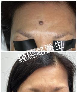 脫除額頭的一粒黑色的凸出的墨痣的術前術後照片對照